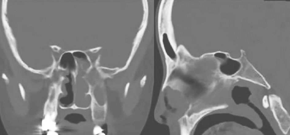 图1鼻窦CT（左侧上颌窦、筛窦、蝶窦和鼻道内病变）