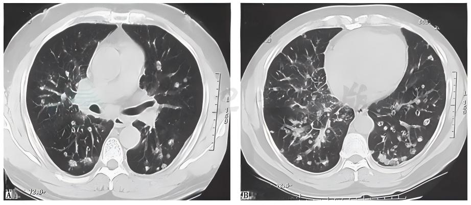 图3肺转移性腺癌胸部CT表现