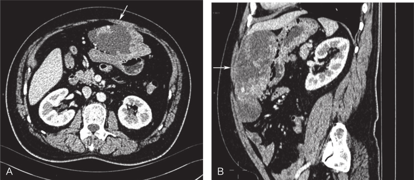 图1术前全腹部及盆腔增强CT
