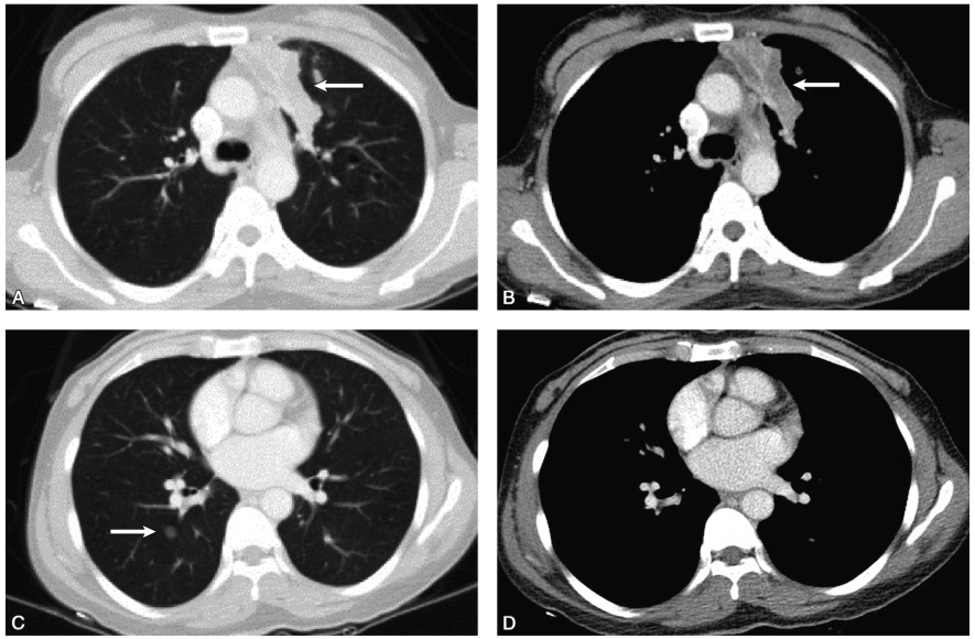 图1胸部CT增强示左肺上叶前段支扩伴感染，右肺下叶背段8mm磨玻璃结节