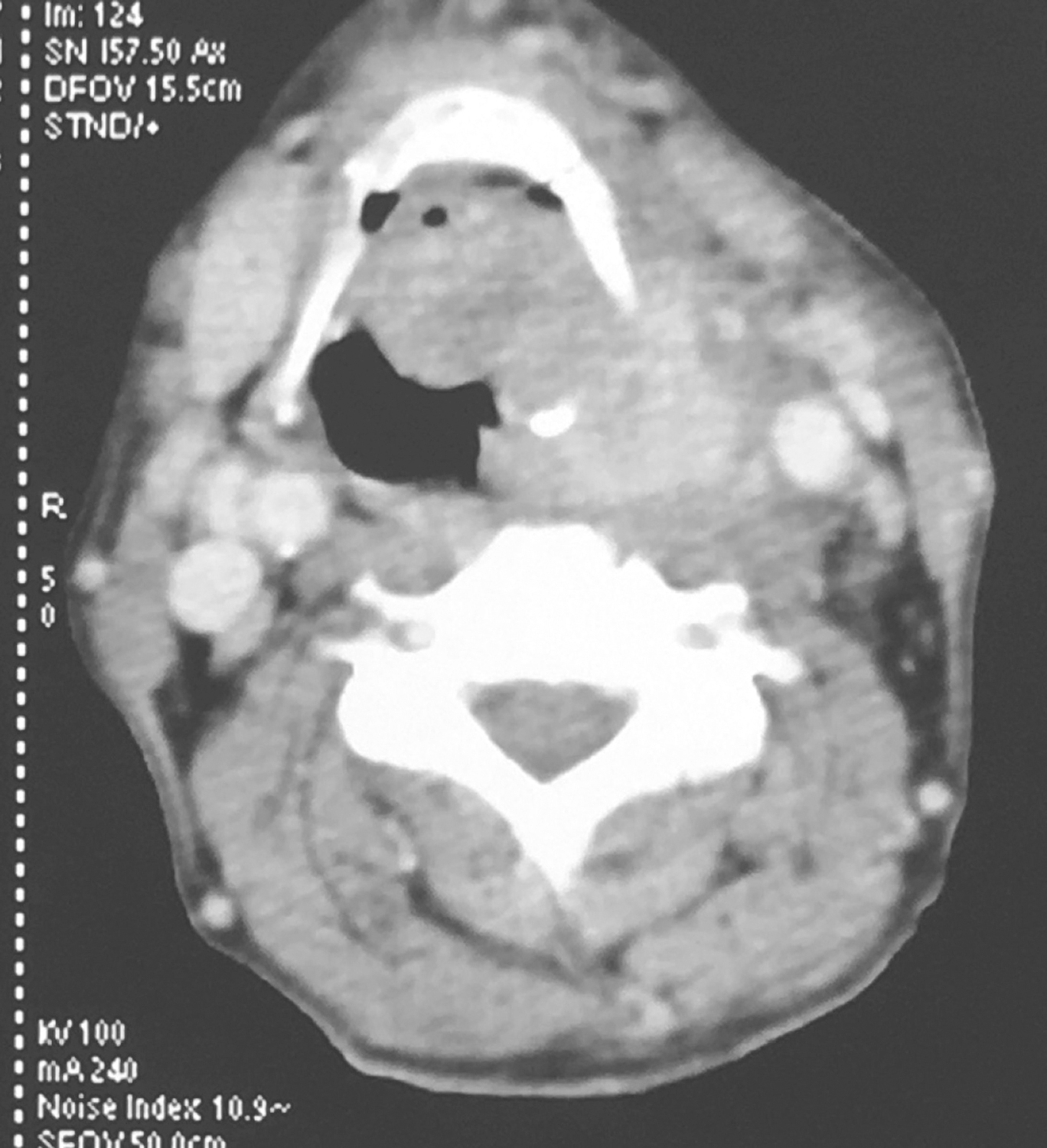 图1下咽部左梨状窝区可见软组织密度影，增强扫描可强化