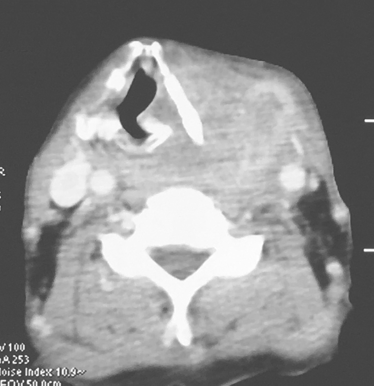 图2向内累及左侧半喉，侵犯会厌前间隙、声门旁间隙，肿瘤侵透甲状软骨板、舌骨、累及咽侧壁及下咽后壁