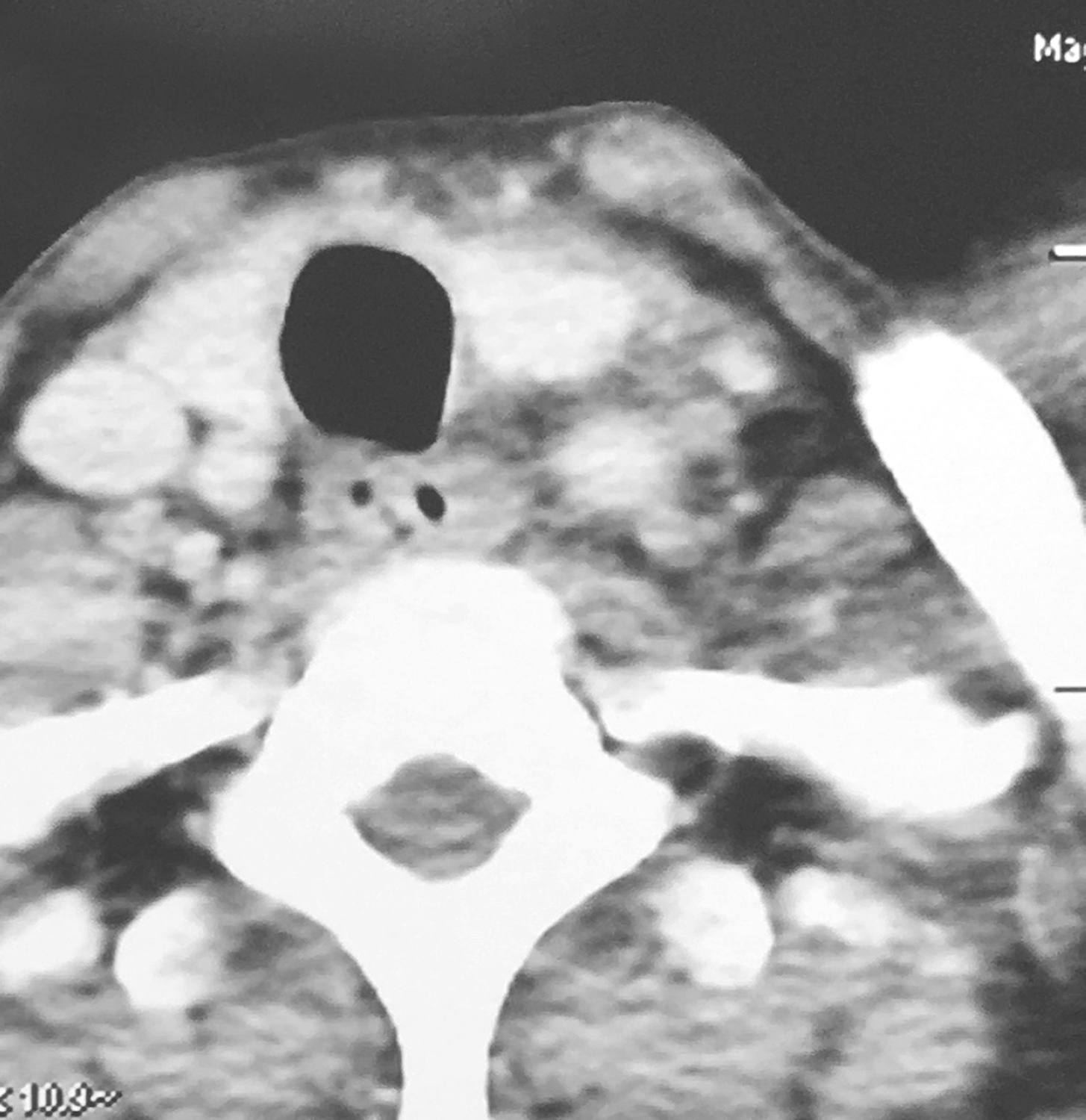 /uploads/image/2025-10-11/160125636图3颈胸部增强CT示颈动脉鞘周围多枚肿大淋巴结.jpg 图3颈胸部增强CT示颈动脉鞘周围多枚肿大淋巴结