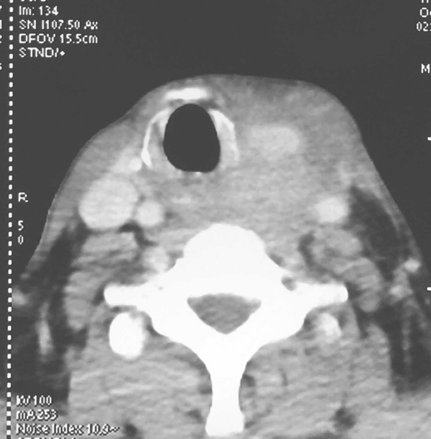 /uploads/image/2025-10-11/160208948图4颈胸部增强CT示颈内静脉闭塞.jpg 图4颈胸部增强CT示颈内静脉闭塞