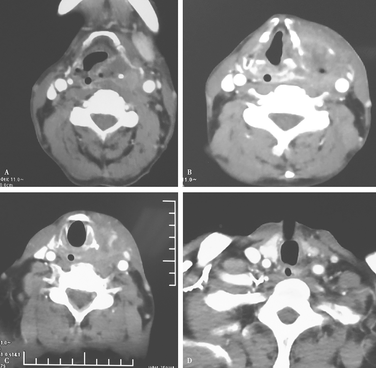 图5颈胸部增强CT示患者原发灶及颈部淋巴结退缩较明显，颈部转移淋巴结与颈动脉鞘粘连减轻