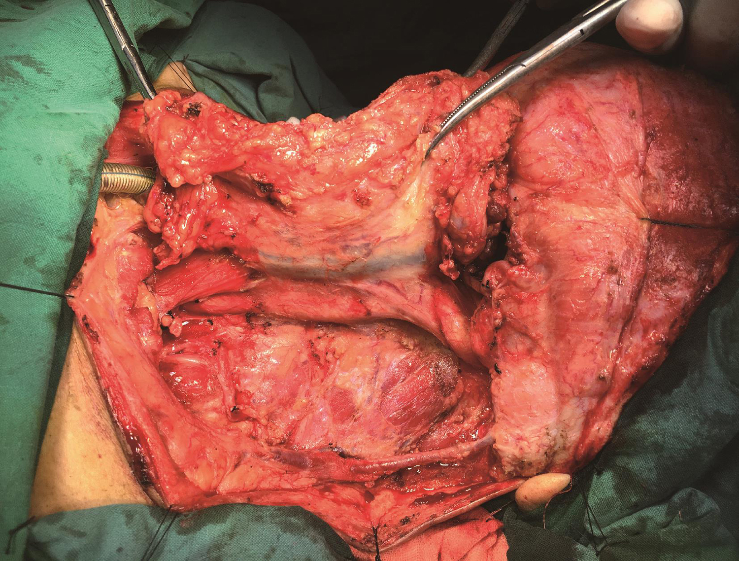 /uploads/image/2025-10-11/160432569图6左颈根治性淋巴结清扫+右颈侧颈清扫.jpg 图6左颈根治性淋巴结清扫+右颈侧颈清扫