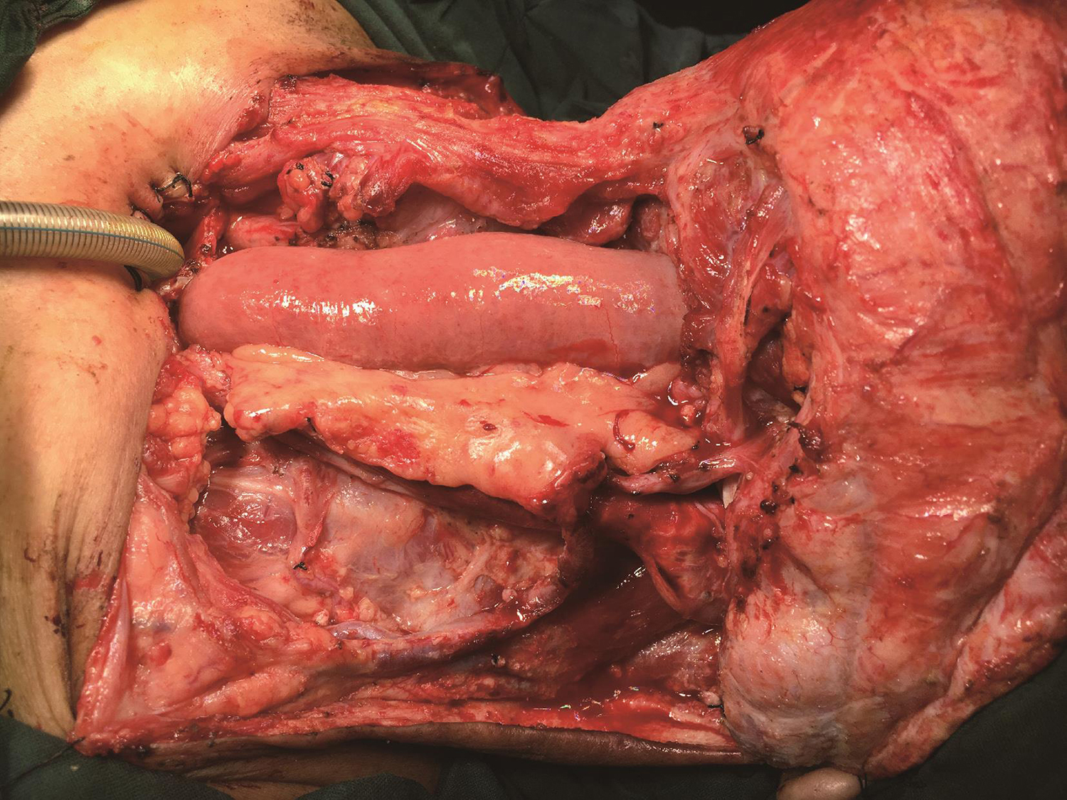 /uploads/image/2025-10-11/160637865图9吻合空肠后.jpg 图9吻合空肠后