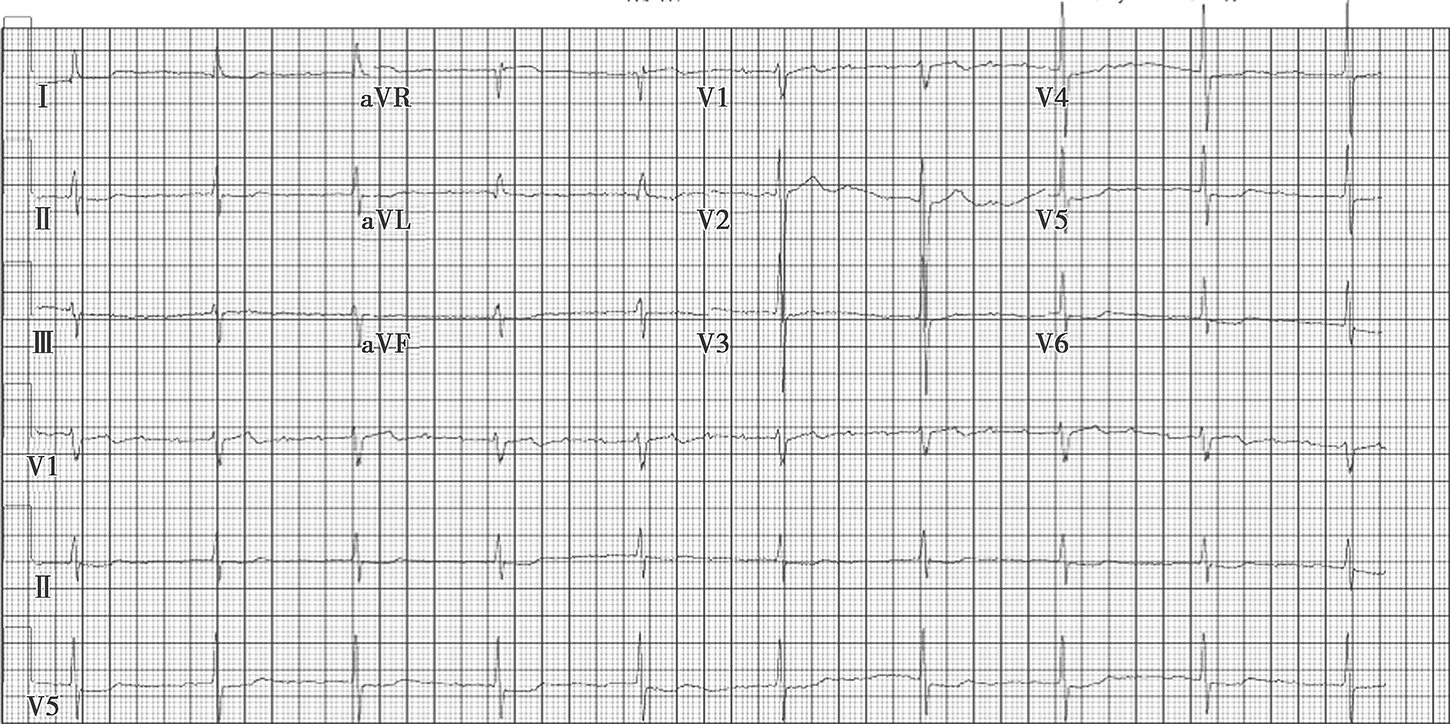 图1入院时心电图