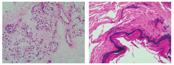 /uploads/image/2025-10-24/212900871图1血管壁淀粉样变.jpg 图1血管壁淀粉样变