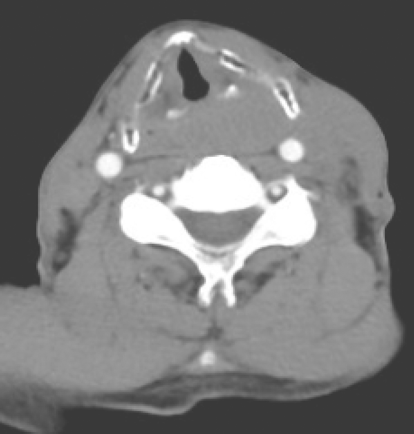 /uploads/image/2025-10-24/214023041图1颈胸部增强CT示双侧杓会厌皱襞、环后可见软组织密度肿物.jpg 图1颈胸部增强CT示双侧杓会厌皱襞、环后可见软组织密度肿物