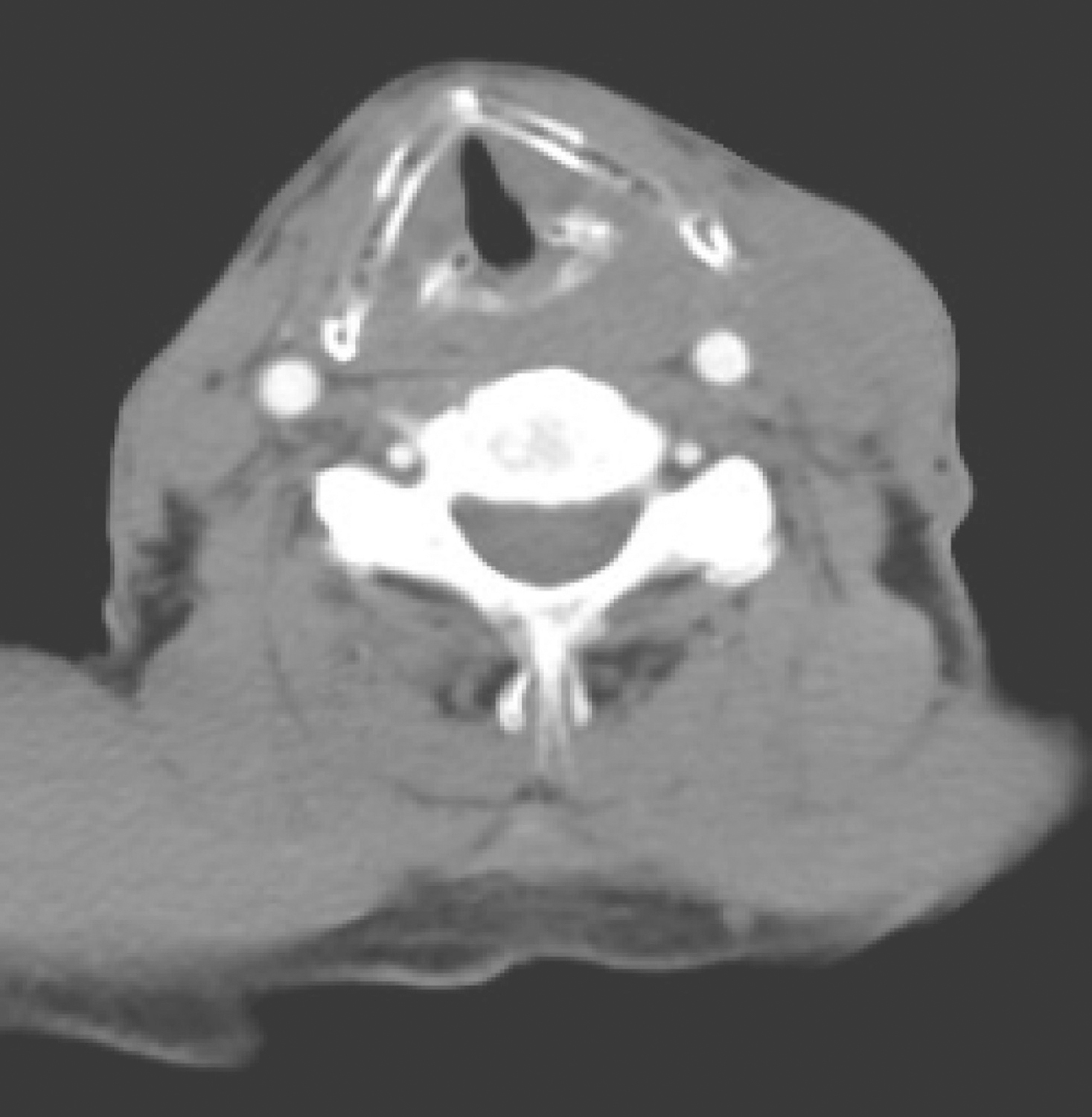 /uploads/image/2025-10-24/214056661图2颈胸部增强CT示左侧颈部胸锁乳突肌内侧肿大淋巴结影.jpg 图2颈胸部增强CT示左侧颈部胸锁乳突肌内侧肿大淋巴结影