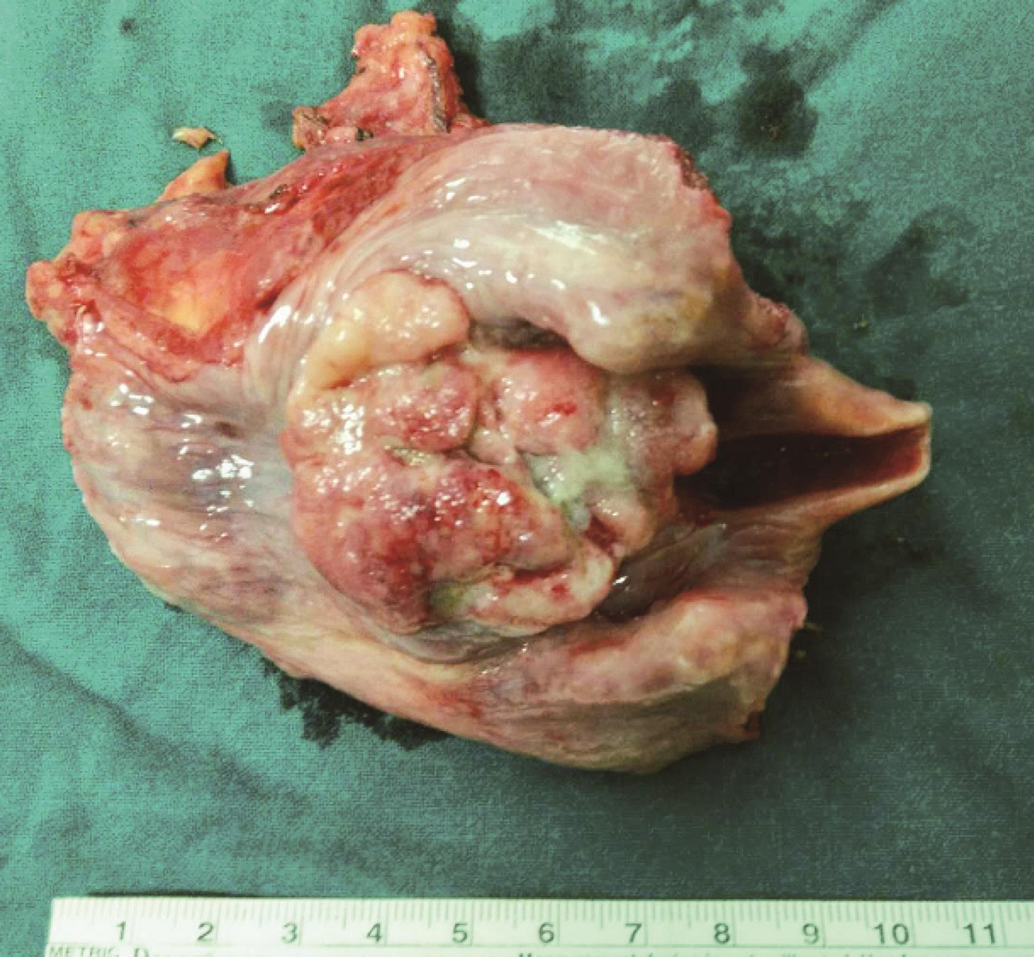 /uploads/image/2025-10-24/214249672图3术中切除标本.jpg 图3术中切除标本