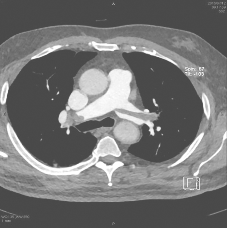 图1CTPA可见左、右肺动脉低密度充盈缺损