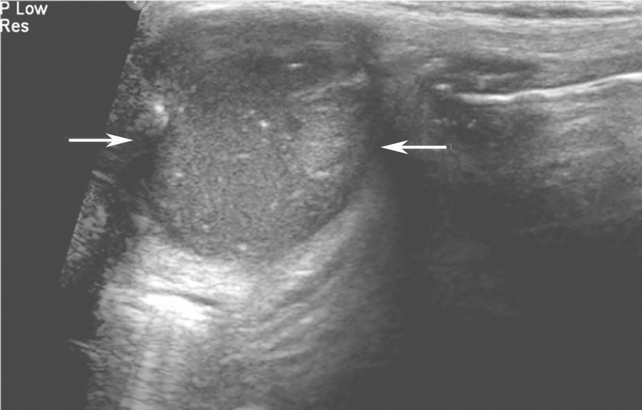 图1颈部正中纵切面：甲状腺峡部上方无回声（箭头所示），内部回声复杂，可见散在点状及絮状回声