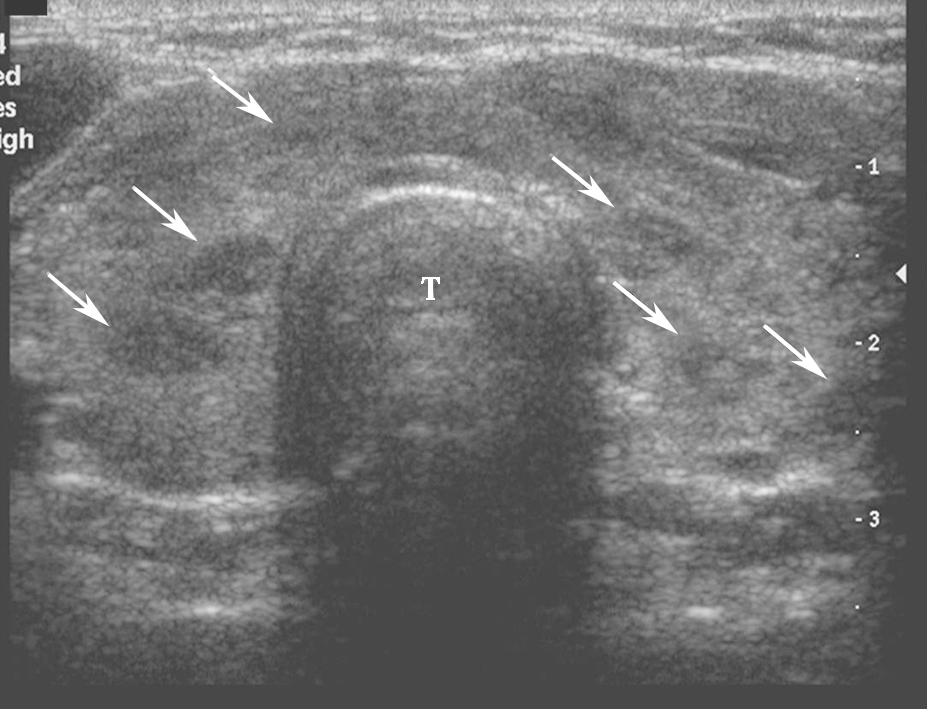 图2颈部正中横切面：甲状腺腺体回声不均匀，峡部增厚，可见多个无占位效应的低回声小结节（箭头所示），T：气管