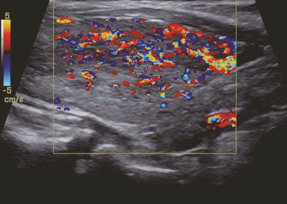 图3右侧颈部纵切面：甲状腺右叶腺体血流信号丰富，呈“火海征”