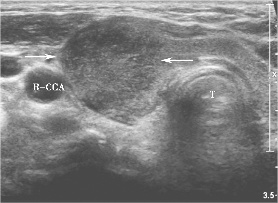 图5颈部正中偏右侧横切面：甲状腺右叶饱满，可见片状低回声，边界模糊（箭头所示）R-CCA：右侧颈总动脉，T：气管