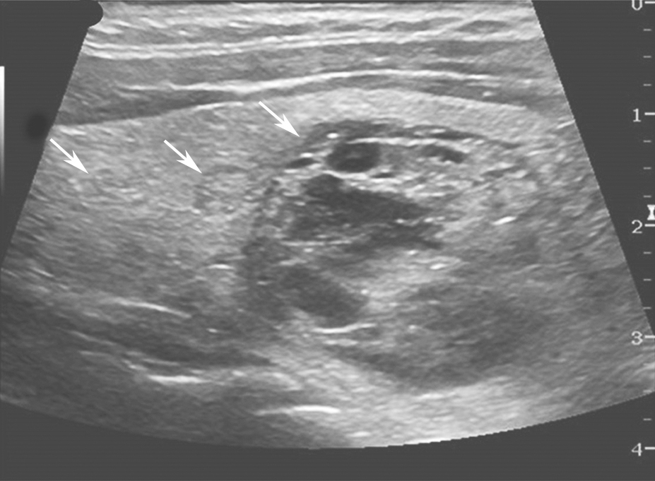图6右侧颈部纵切面：甲状腺右叶腺体内可见多个大小不等、回声不一结节（箭头所示），最大者内可见囊性成分
