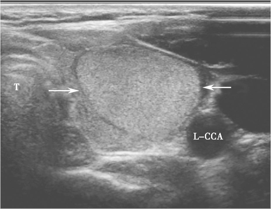 图7颈部正中偏左横切面：甲状腺左叶中等回声，形态规则、边界清晰，伴薄声晕（箭头所示）。T：气管；L-CCA：左侧颈总动脉