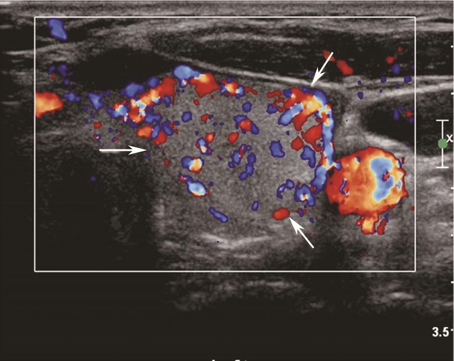 图8颈部正中偏左横切面（与图3-3-7同患者、同切面）：中等回声可见丰富规则彩色多普勒血流信号（箭头所示）