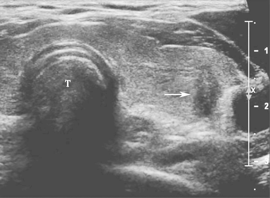 图9颈部正中偏左横切面：甲状腺左叶可见极低回声（箭头所示），形态多不规则，边界不清，纵横比大于1，内可疑点状强回声（微小钙化）T：气管