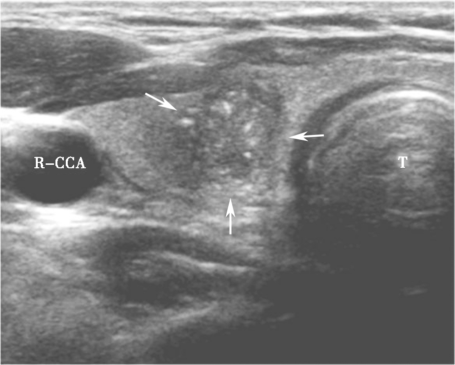 图10颈部正中偏右横切面：甲状腺右叶可见低回声（箭头所示），形态多不规则，边界不清，内可见点状强回声（微小钙化）。T：气管；R-CCA：右侧颈总动脉