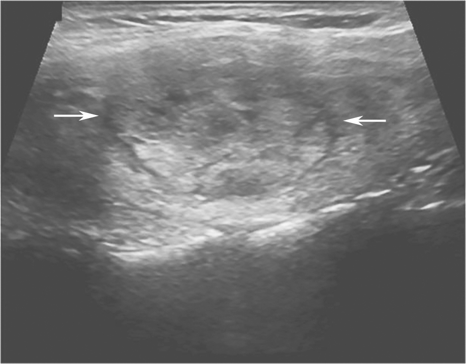 图11右侧颈部纵切面：甲状腺右叶中部中等回声（箭头所示）：内部回声不均伴厚薄不一低回声晕
