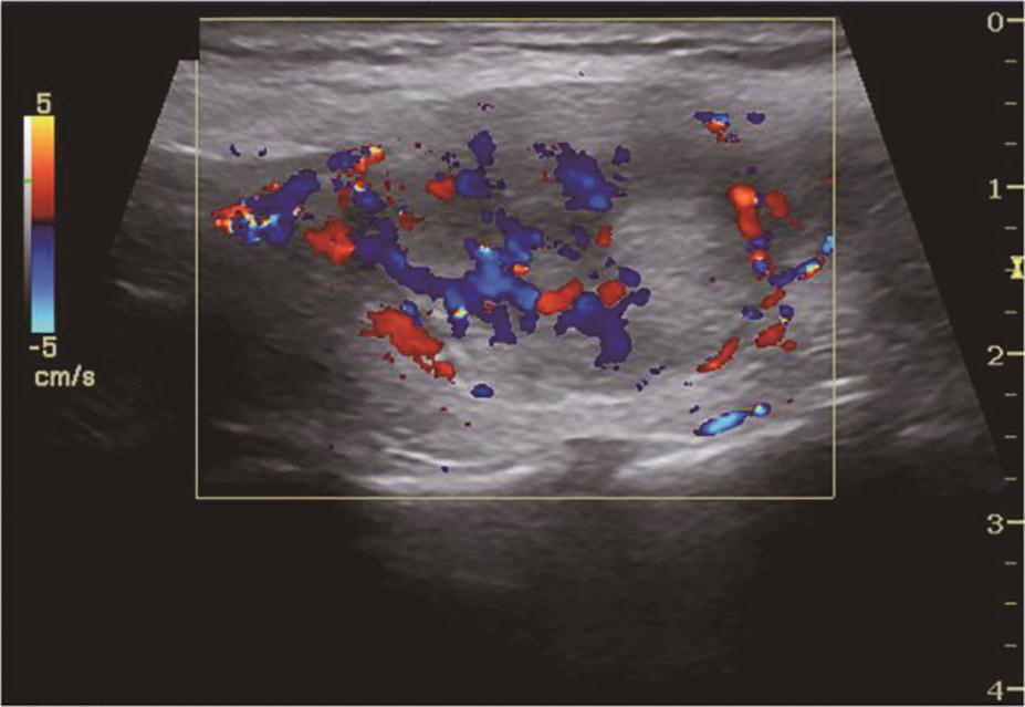 图12右侧颈部纵切面（与图3-3-11同患者、同切面）：中等回声彩色多普勒血流信号丰富而杂乱