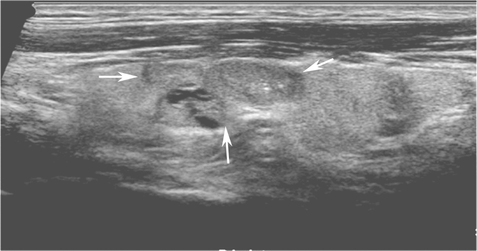 图13左侧颈部纵切面：甲状腺左叶中部中低回声（箭头所示），分叶状，可见囊性成分及点状强回声（微小钙化）