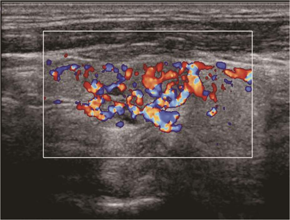 图14左侧颈部纵切面（与图3-3-13同患者、同切面）：甲状腺左叶中部中低回声内部彩色多普勒血流信号丰富而杂乱