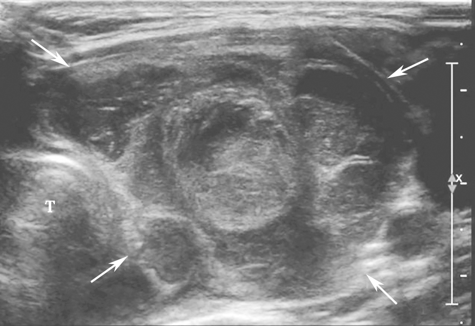 图15颈部正中偏左横切面：甲状腺左叶可见不均匀低回声，形态不规则，边界模糊（箭头所示）