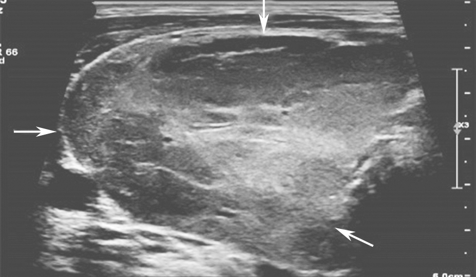 图16颈部正中偏右横切面：甲状腺右叶极低回声，占据整个腺体（箭头所示）