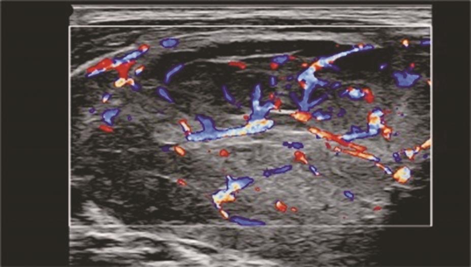 图17颈部正中偏右横切面：极低回声内可见丰富杂乱彩色多普勒血流信号