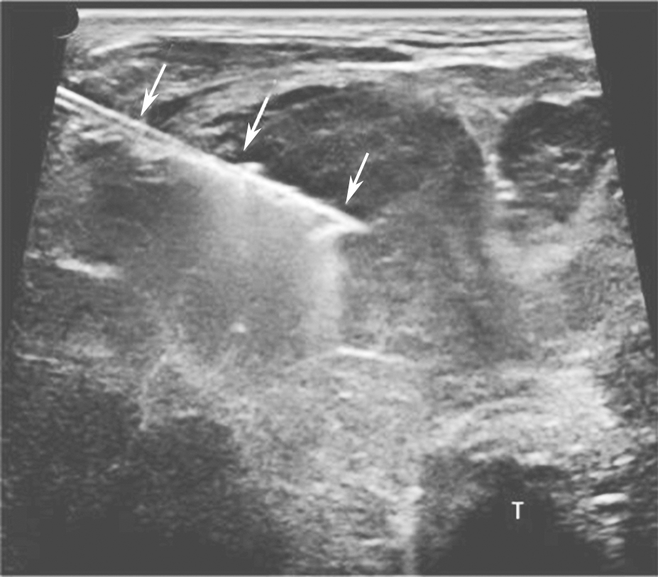 图18颈部正中偏右横切面：甲状腺右叶粗针组织活检，箭头所示为穿刺针回声