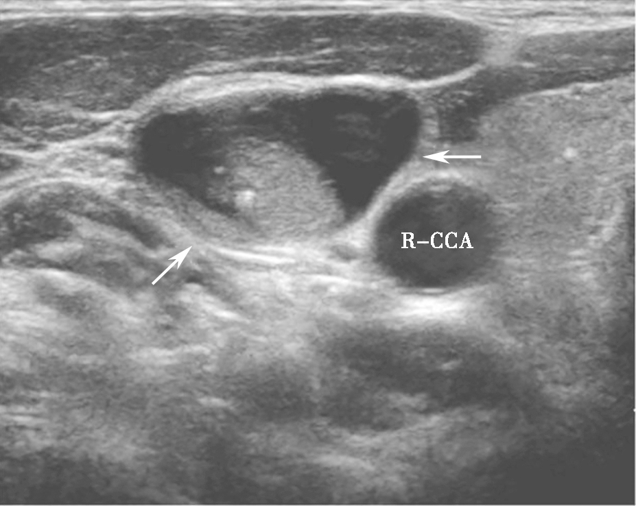 图19颈右侧横切面：甲状腺乳头状癌患者，颈部侧方Ⅳ区可见囊实性混合回声（箭头所示），实性成分偏心分布，内可见点状回声，手术证实为颈侧方淋巴结转移