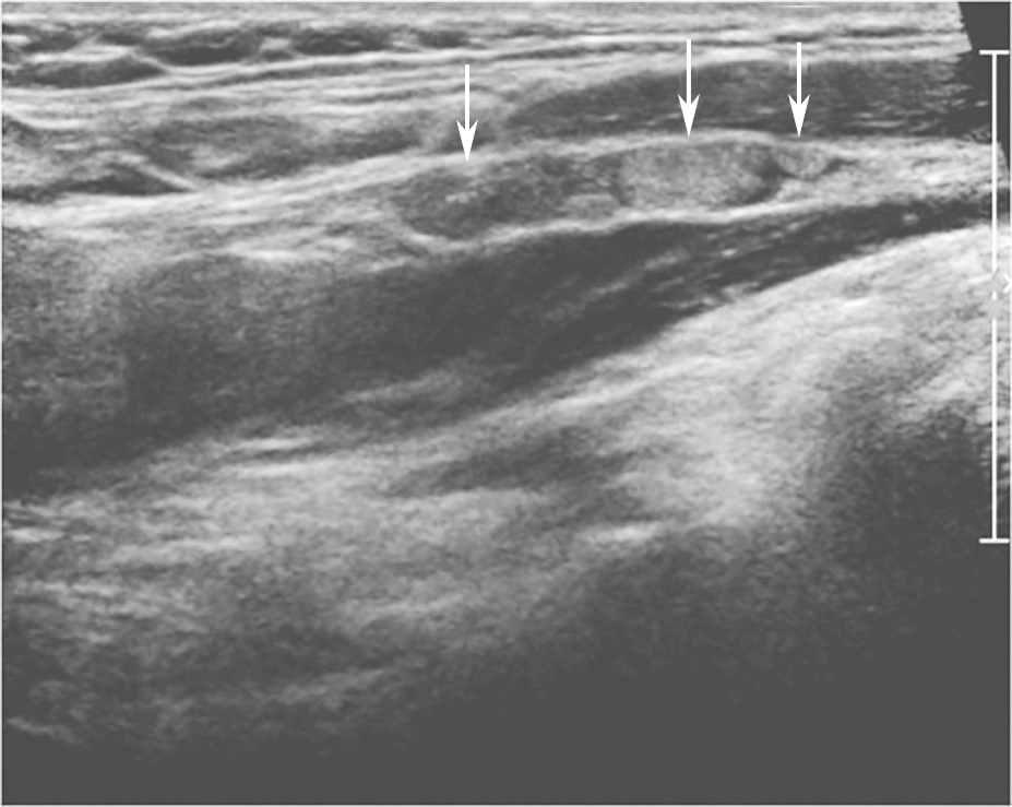 图20颈左侧纵切面：甲状腺乳头状癌患者，颈部侧方Ⅳ区淋巴结皮髓质分界不清（箭头所示），部分淋巴结内可见团状高回声，手术证实为颈侧方淋巴结转移