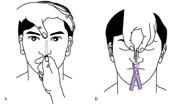 图1鼻骨骨折复位示意图