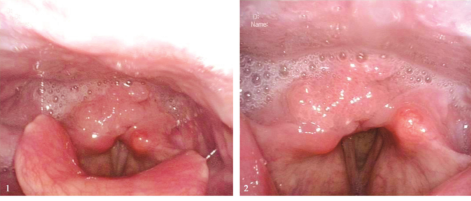 图1电子喉镜示下咽环后区及右侧梨状窝菜花样肿瘤-5980796755101696
