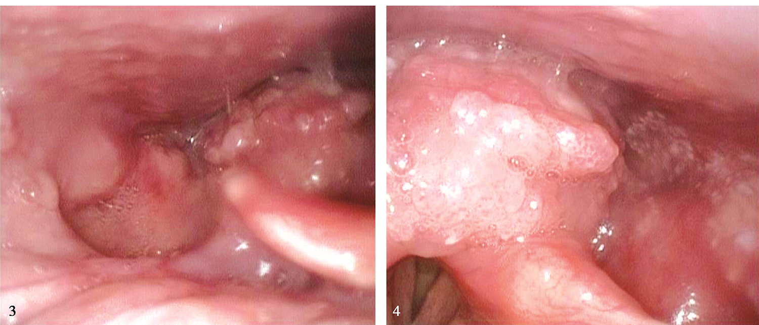 图1电子喉镜示下咽环后区及右侧梨状窝菜花样肿瘤-5980796796405760