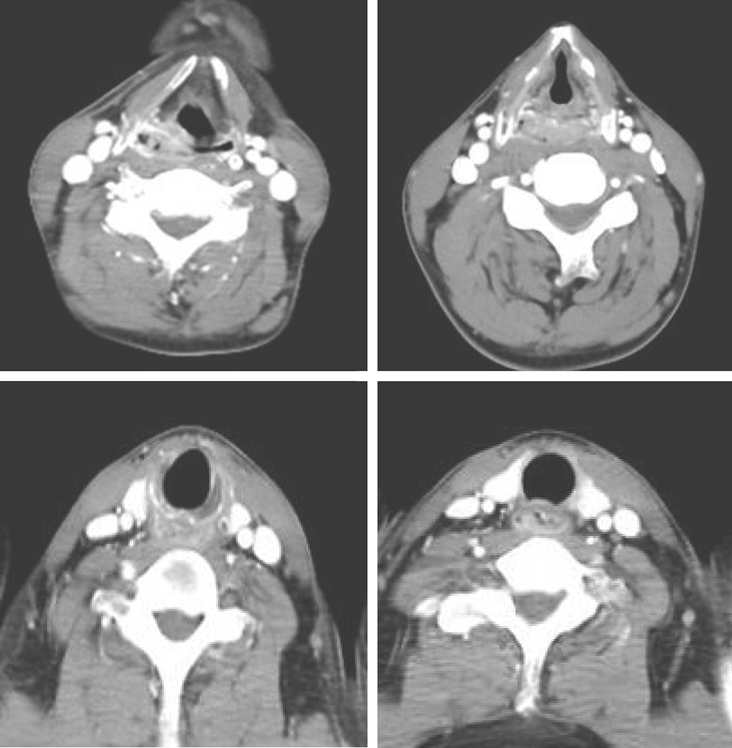 图2颈胸部增强CT示下咽环后区软组织密度影