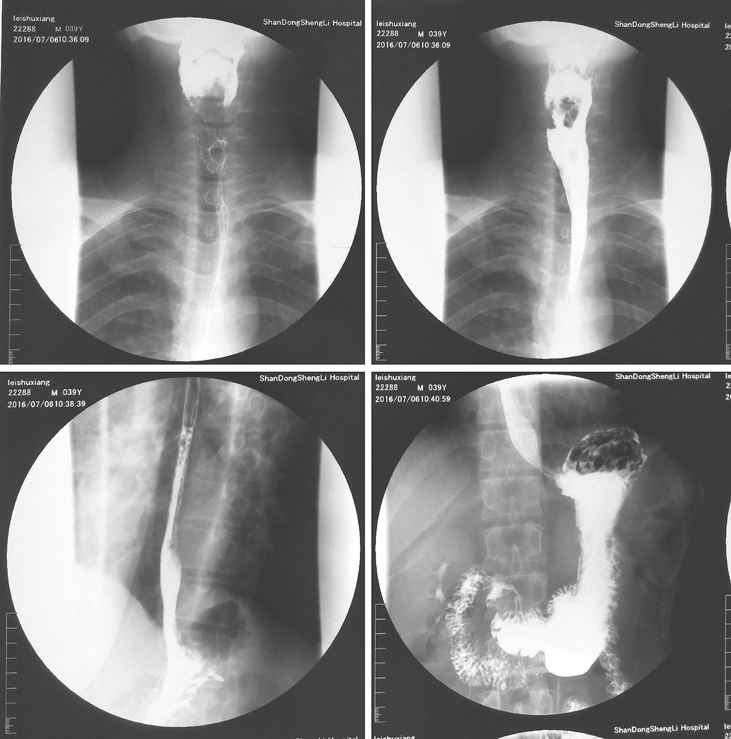 图3上消化道钡餐示下咽部充盈缺损