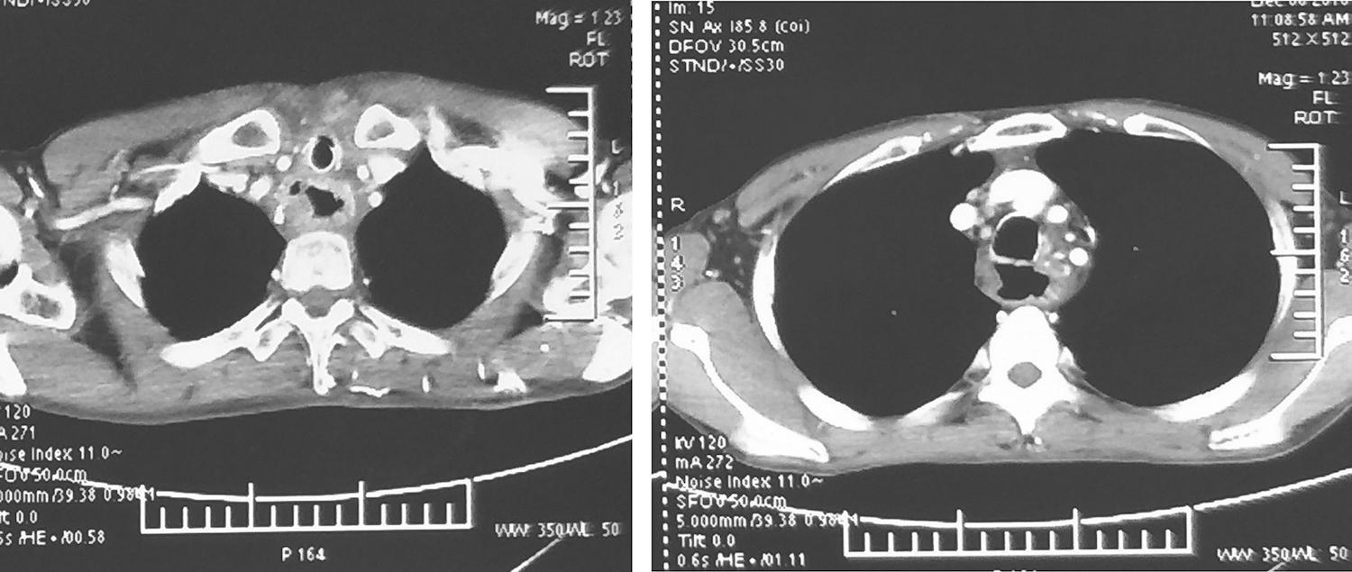 图4颈胸部增强CT示无肿瘤复发或转移