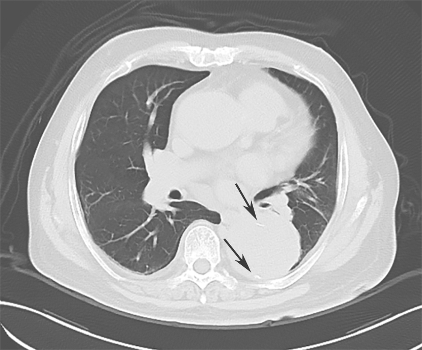 图1肺部CT平扫（箭头处钙化点内移）
