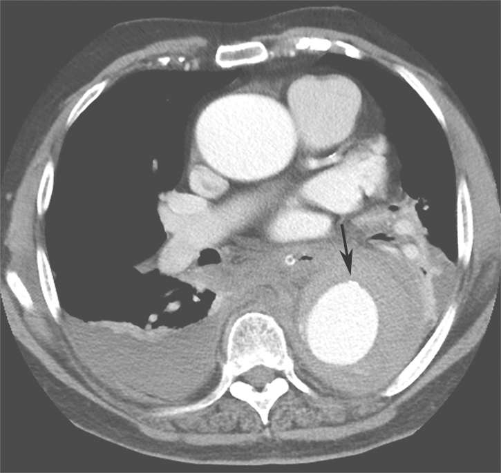 /uploads/image/2025-11-07/221806080图2主动脉CT螺旋扫描+三维重建.jpg 图2主动脉CT螺旋扫描+三维重建