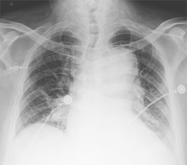 /uploads/image/2025-11-07/222014809图4主动脉夹层导致纵隔影增宽.jpg 图4主动脉夹层导致纵隔影增宽