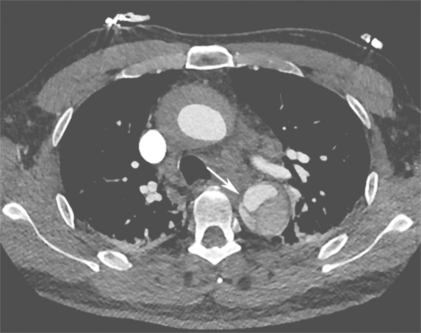 /uploads/image/2025-11-07/222043122图5主动脉夹层破口位置.jpg 图5主动脉夹层破口位置