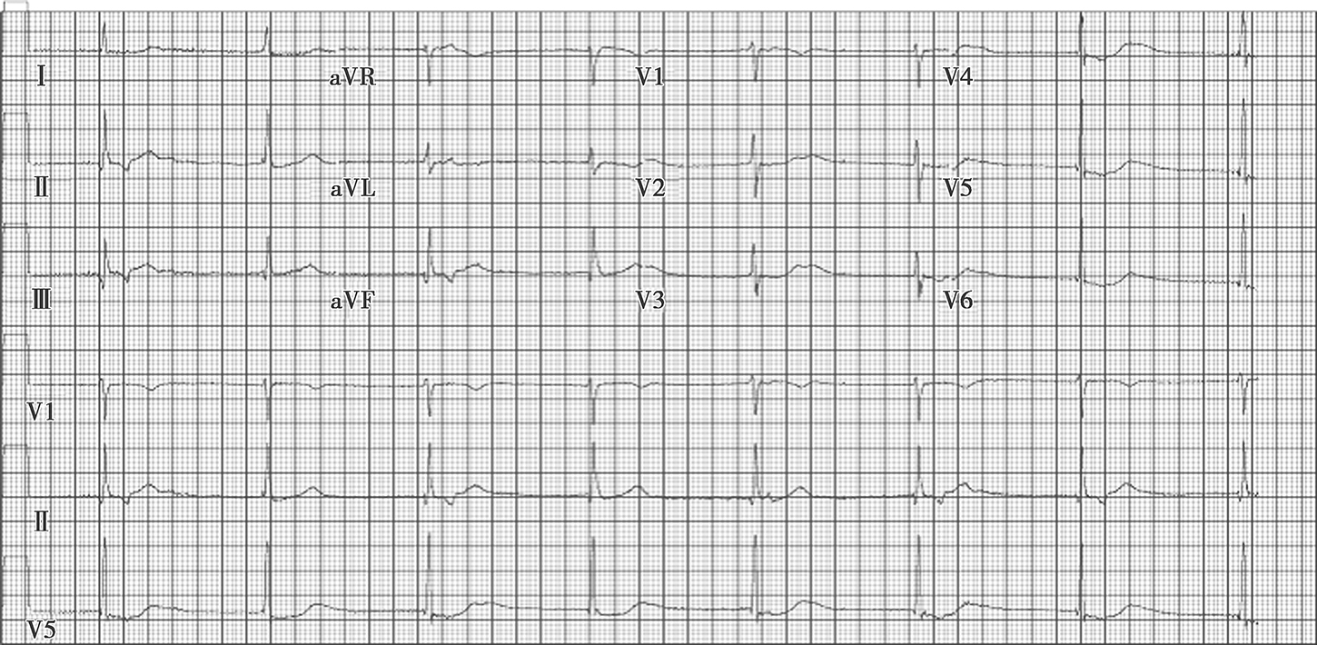 图1入院时心电图：窦性停搏，交界性逸搏心律