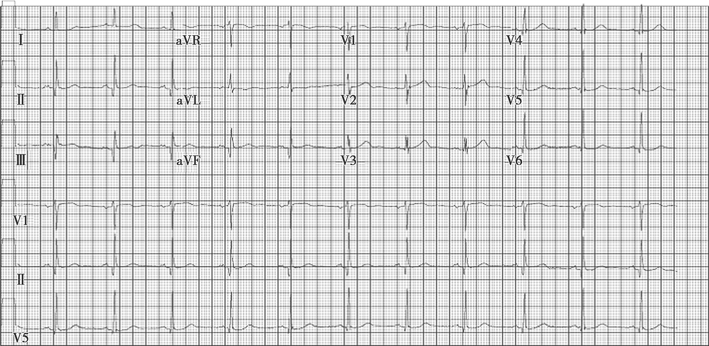 图2窦性心动过缓