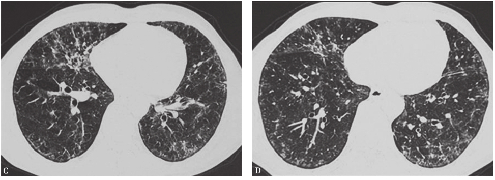 图1外院胸部CT表现-6902305394853888