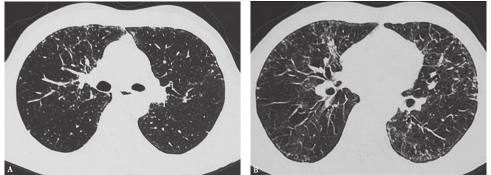 图1外院胸部CT表现-6902307317614592